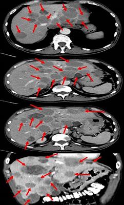 Safety and rapid response of dabrafenib and trametinib therapy during hyperbilirubinemia in metastatic melanoma